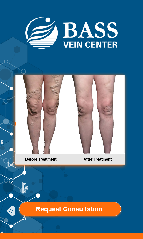 Conservative Vein Treatment BASS Vein Center